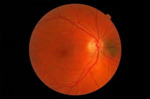 nevus on retina